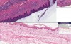 Lymphocytic Infiltrate (Possible Tick Bite)