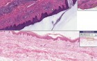 Lymphocytic Infiltrate (Possible Tick Bite)