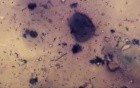 Sarcoidosis - Blood Streaked Sputum