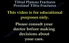Tibial Plateau Fractures Proximal Tibia Fractures 