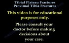 Tibial Plateau Fractures Proximal Tibia Fractures 