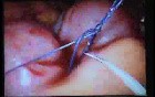 Jejunal Gastrointestinal Stromal tumor (GIST) (78 of 86)