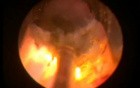 Greenlight Vaporization - Urethral Strictures
