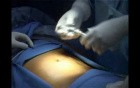 Total Extra Peritoneal (TEP) in 10 steps - Part 1