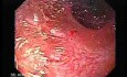 Ileal Neobladder Substitution (ileal bladder) (7 of 9)