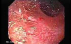 Ileal Neobladder Substitution (ileal bladder) (7 of 9)