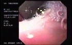 Banding of Esophageal Varices - Presence of Ulcer After Ligation