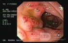 Amebic Colitis