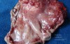 Diffuse Adenocarcinoma with signet ring cells (9 of 18)