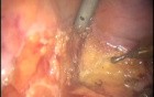 Robotic Colo-Anal Pullthrough Procedure - Difficult Male Pelvis