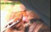 Danger Area Of Face Regarding An Infection