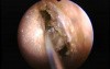 Anterior Ethmoidectomy - Endoscopy