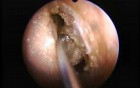 Anterior Ethmoidectomy - Endoscopy