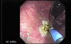 Rectal Dieulafoy’s Lesion (4 of 4)