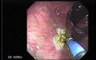 Rectal Dieulafoy’s Lesion (4 of 4)