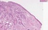 Squamous cell carcinoma