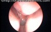 Right-Sided Antrochoanal Polyp