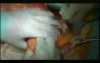 Open Right Hemicolectomy – Technical Principles - Operation No 1 - Part 2