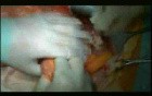 Open Right Hemicolectomy – Technical Principles - Operation No 1 - Part 2