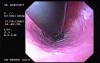 Hemorrhage due status post rubber band ligation of esophageal varices (4 of 25)