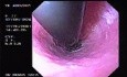 Hemorrhage due status post rubber band ligation of esophageal varices (4 of 25)