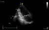 Simpson's Biplane Method for Accurate Assessment of Left Ventricular Ejection Fraction