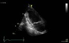 Simpson's Biplane Method for Accurate Assessment of Left Ventricular Ejection Fraction
