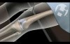 Open Reduction Internal Fixation of Femur Fracture
