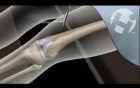Open Reduction Internal Fixation of Femur Fracture