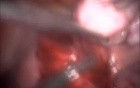 Laparoscopic Myomectomy 