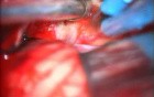 Acoustic Schwannoma