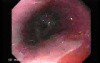 Barrett's Esophagus of long segment (6 of 24)