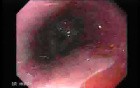 Barrett's Esophagus of long segment (6 of 24)