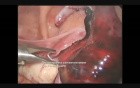 Еctopic Pregnancy