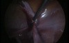 Misdiagnosis of a Right Broad Ligamentary Cyst Managed by Laparoscopy
