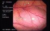 Splenic Flexure (1 of 2)