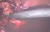 Laparoscopic Supracervical (Subtotal) Hysterectomy - LASH