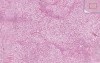 Liver - Fatty Change 3