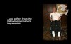 Neck Fracture with Anterior/Posterior Fusion