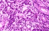 Diffuse Adenocarcinoma with signet ring cells (15 of 18)