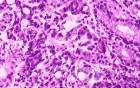 Diffuse Adenocarcinoma with signet ring cells (15 of 18)