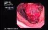 Familial Adenomatous Polyposis of the Colon (1 of 29)
