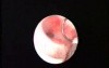 Hysteroscopic Endometrial Ablation