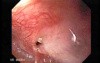 Colonic Interposition for Esophageal Substitution (1 of 11)