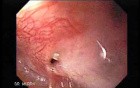 Colonic Interposition for Esophageal Substitution (1 of 11)