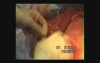 Esophagogastrectomy - Esophageal Cancer Surgery