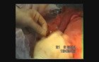 Esophagogastrectomy - Esophageal Cancer Surgery