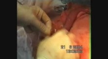Esophagogastrectomy - Esophageal Cancer Surgery