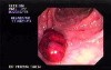 Familial Adenomatous Polyposis of the Colon (2 of 29)
