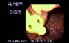 Percutaneous Endoscopic Gastrostomy (3 of 3)